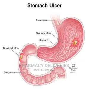 Ulcer Treatment and Medical Management Services Available