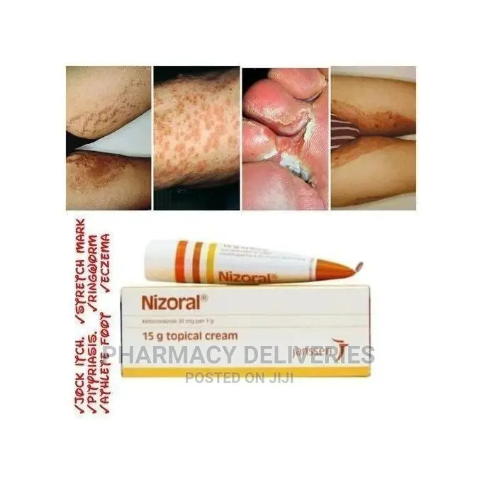 Nizoral Cream for Treatment of Fungal Infections Fungus in Wuse 2
