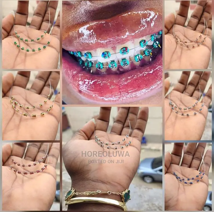 Teeth Braces in Ibadan Jewellery, Promise Olatunde Jiji.ng