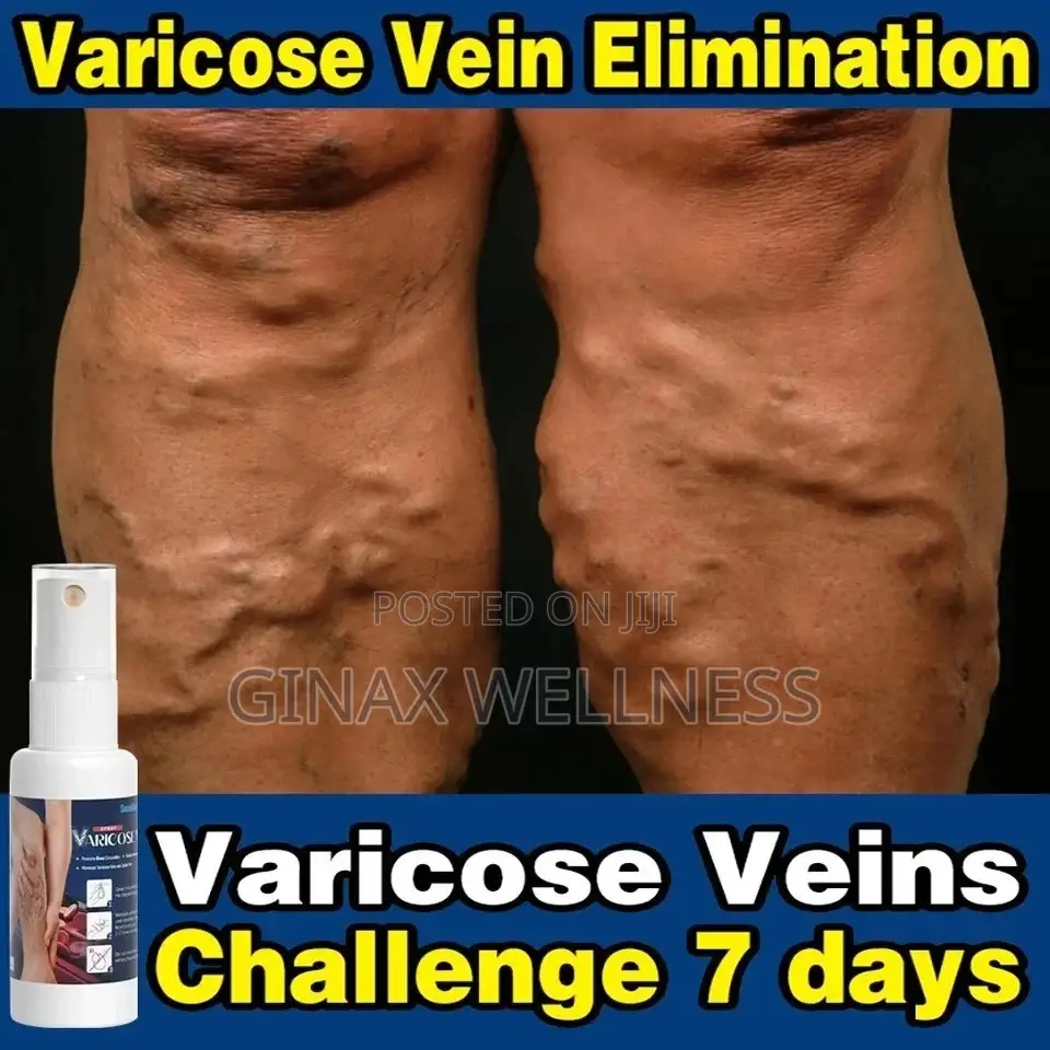 Varicose Veins Spray