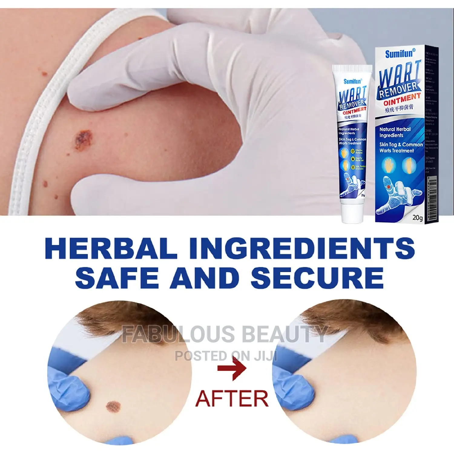 Wart Remover Ointment,20g