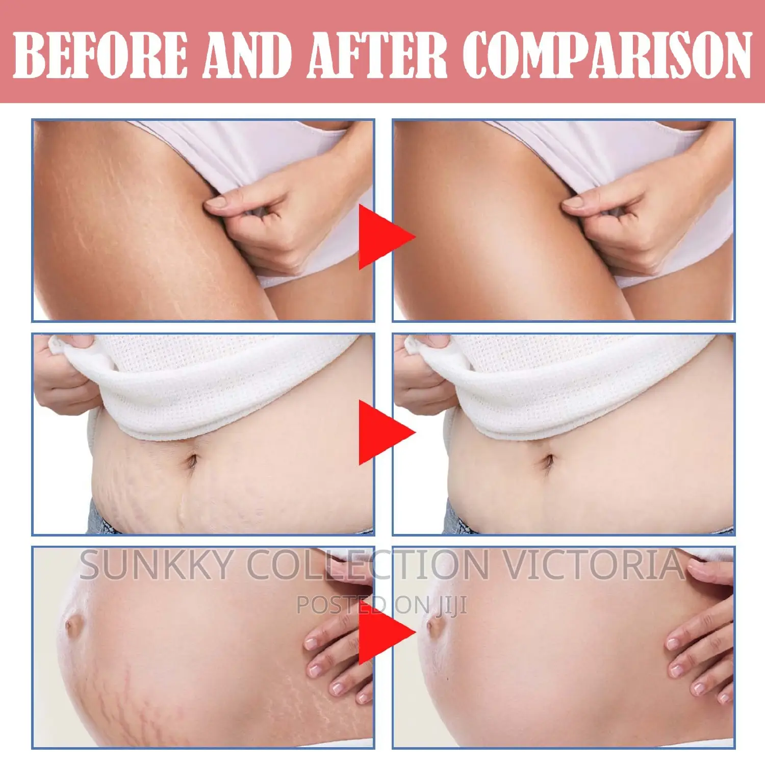 Postpartum Stretch Mark Repair Cream