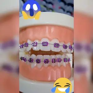 Teeth Fashion Braces