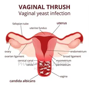 PID Treatment (Pelvic Inflammatory Disease) Candidiasis