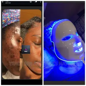 Acne and Pimples Facials Treatment