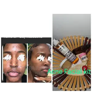 Acne/Pimples KIT
