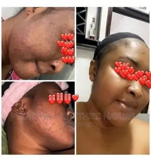 Acne And Pimples Treatment