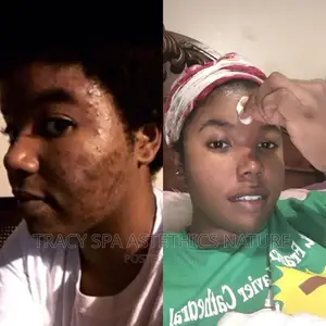 Acne Facial Treatment