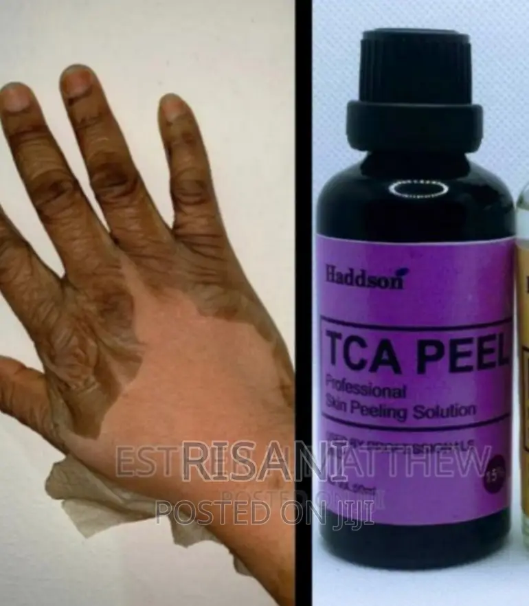 TCA Chemical Professional Acid Peel