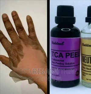 TCA Chemical Professional Acid Peel