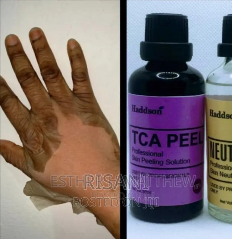 TCA Chemical Professional Acid Peel