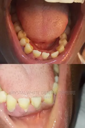 Teeth Cleaning