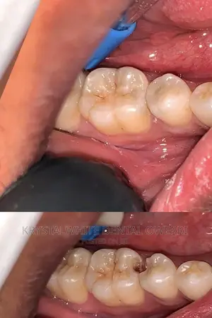 Teeth Filling