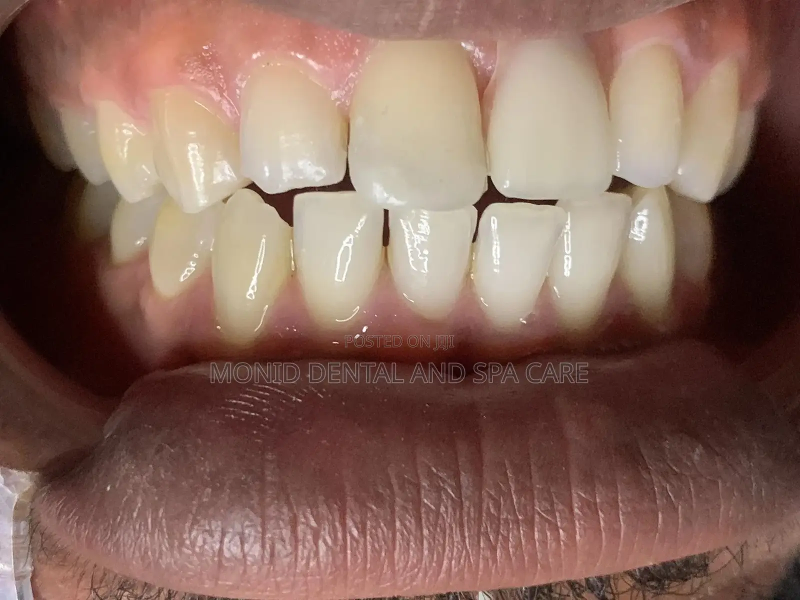 Tooth Replacement