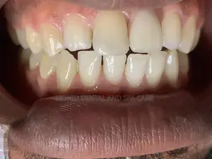 Tooth Replacement