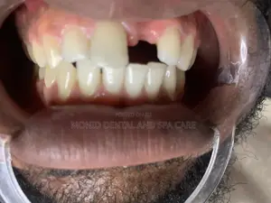 Tooth Replacement