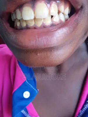 Scaling And Polishing Of The Teeth And Whitening