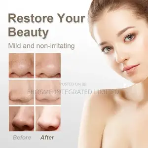 Blackhead Remover Vacuum