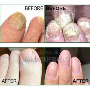 Sumifun Nail Fungus Treatment Cream-30g