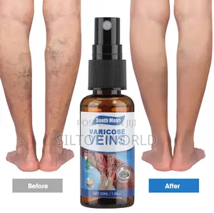Varicose Veins
