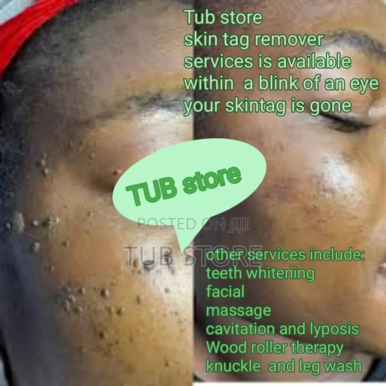 Skin Tag Remover Services