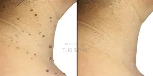 Skin Tag Remover
