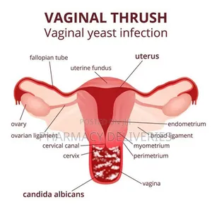 Treatment of Candidiasis Bacteria, Fungi and Yeast Infection