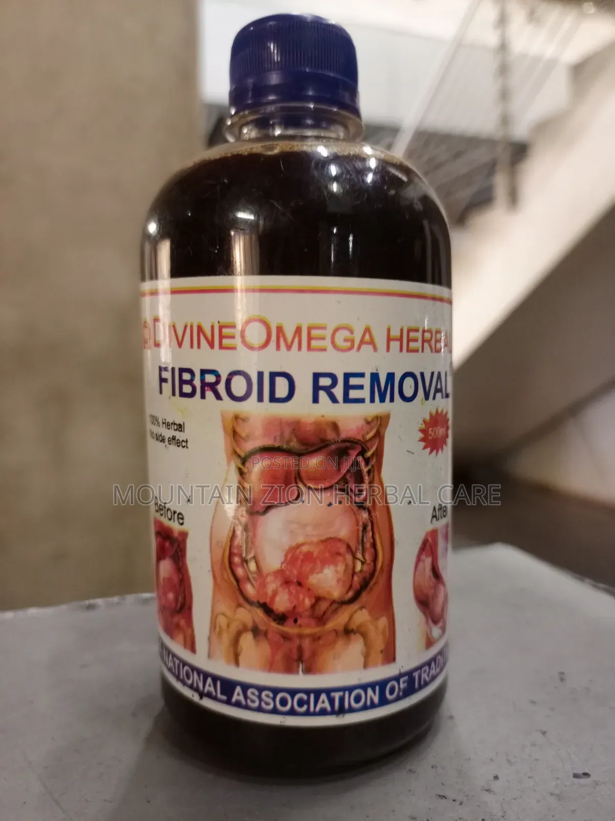 Fibroid Removal
