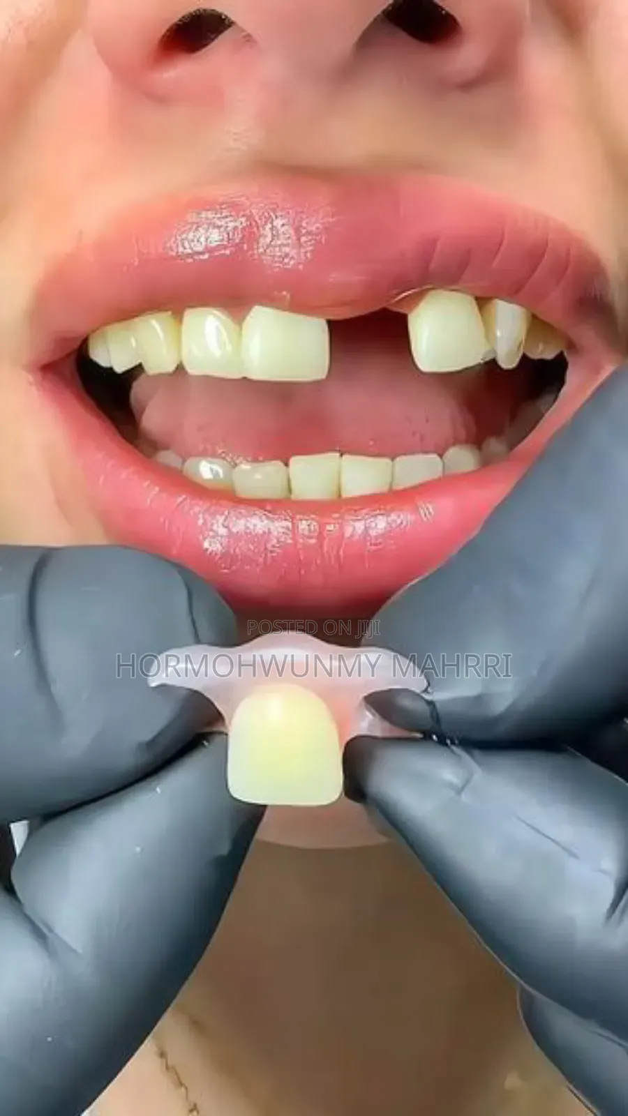 Teeth Replacement