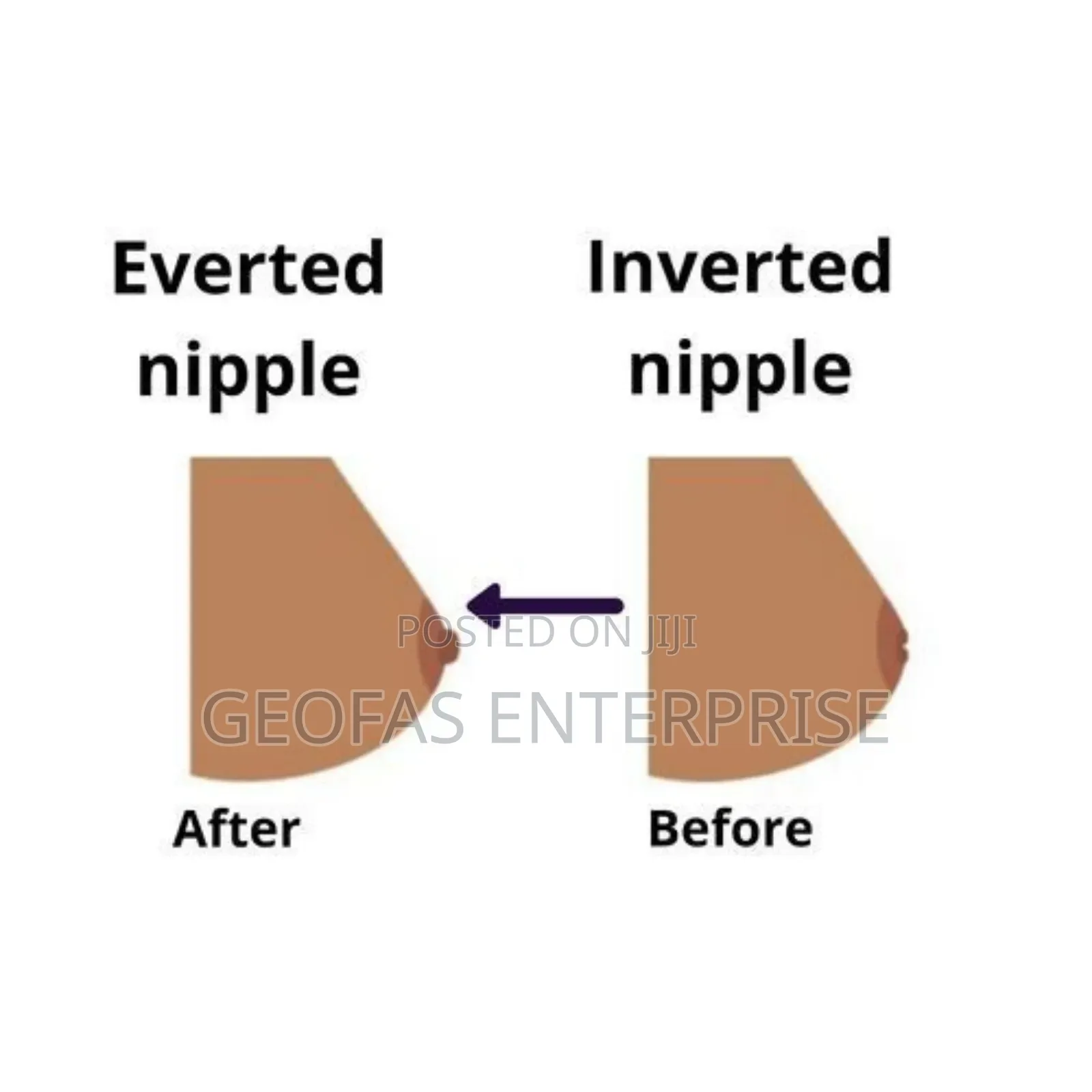 Nipple Corrector Shield Flat Inverted Shy Breast Nipples 2pc