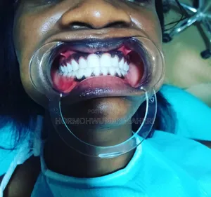 Laser Teeth Whitening