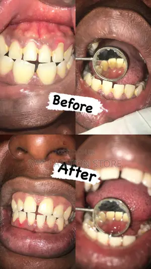 Teeth Cleaning