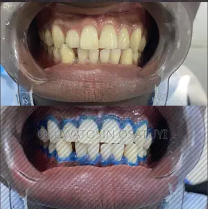Teeth Whitening