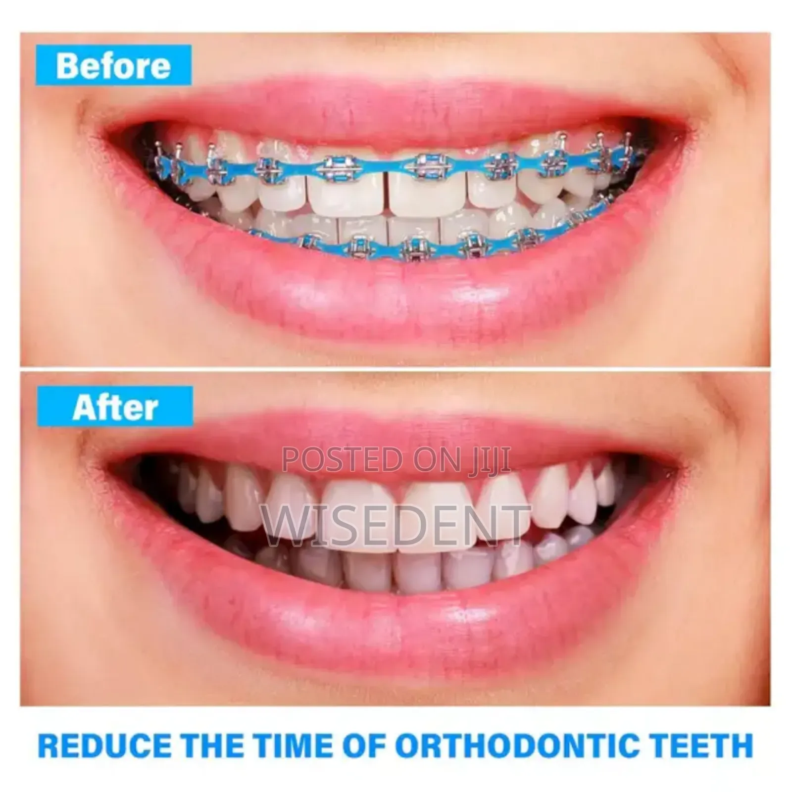 Orthodontic Power Chain