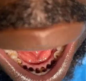 Teeth Stain Removal
