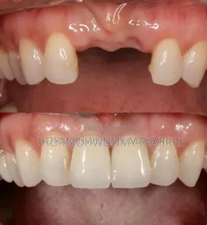 Teeth Replacement