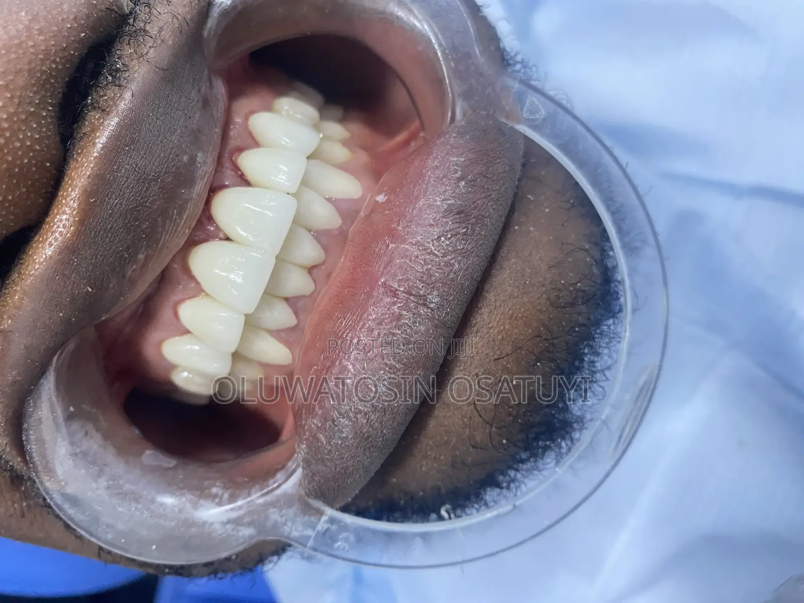 White Veneers