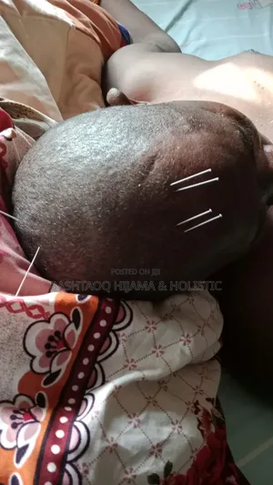 Hijama (Cupping) And Acupuncture Services