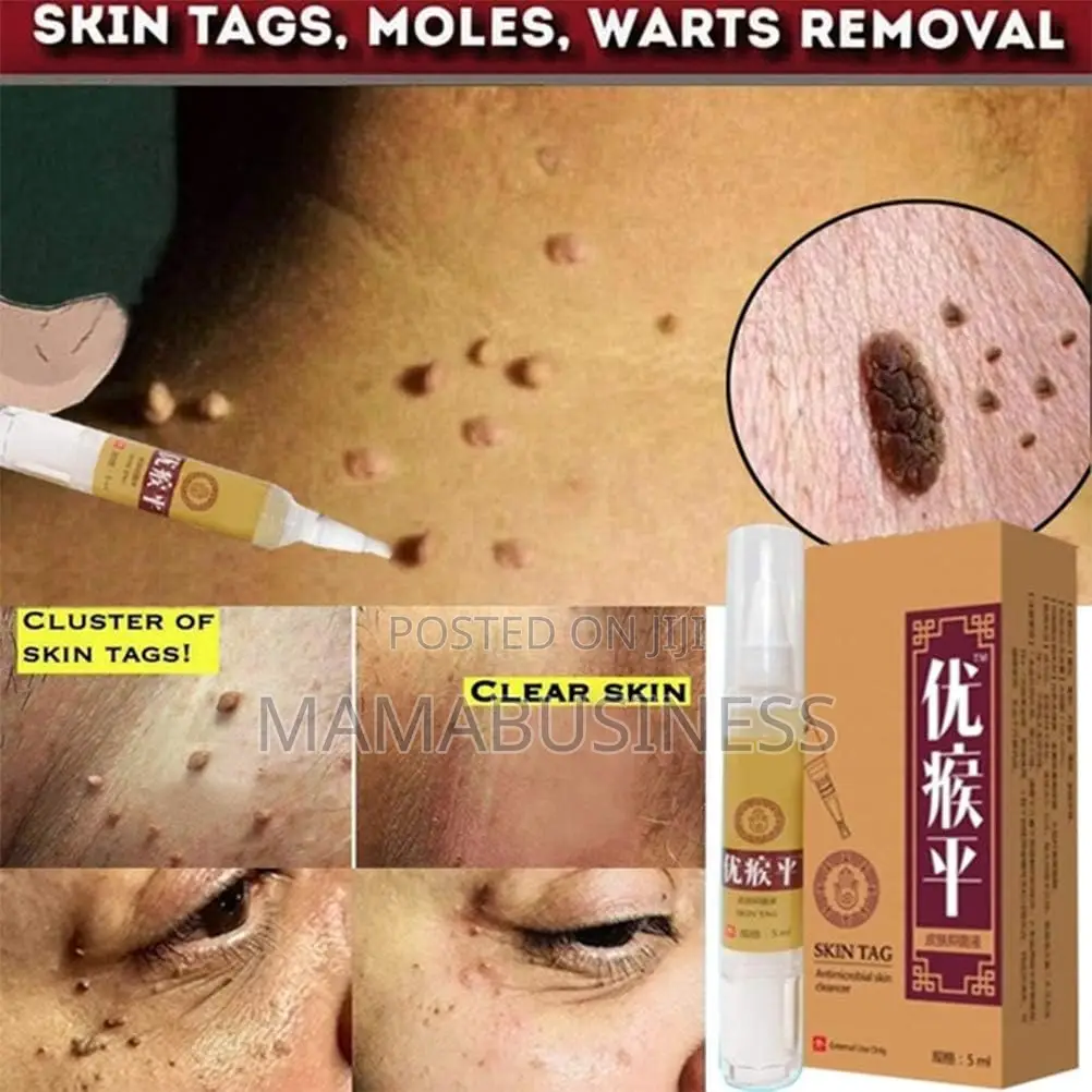 Aonisen Skin Tag - 5ml