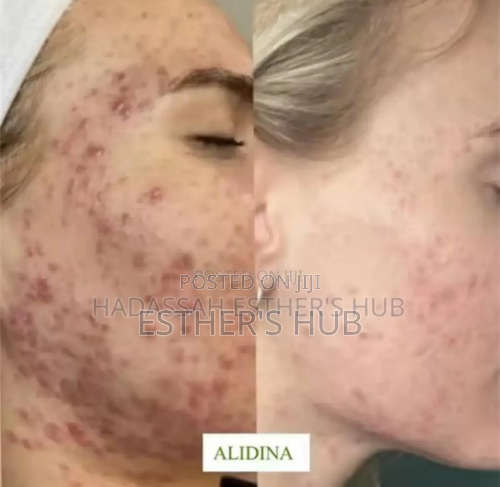 Algae Peel,Bio Microneedling Therapy Algae