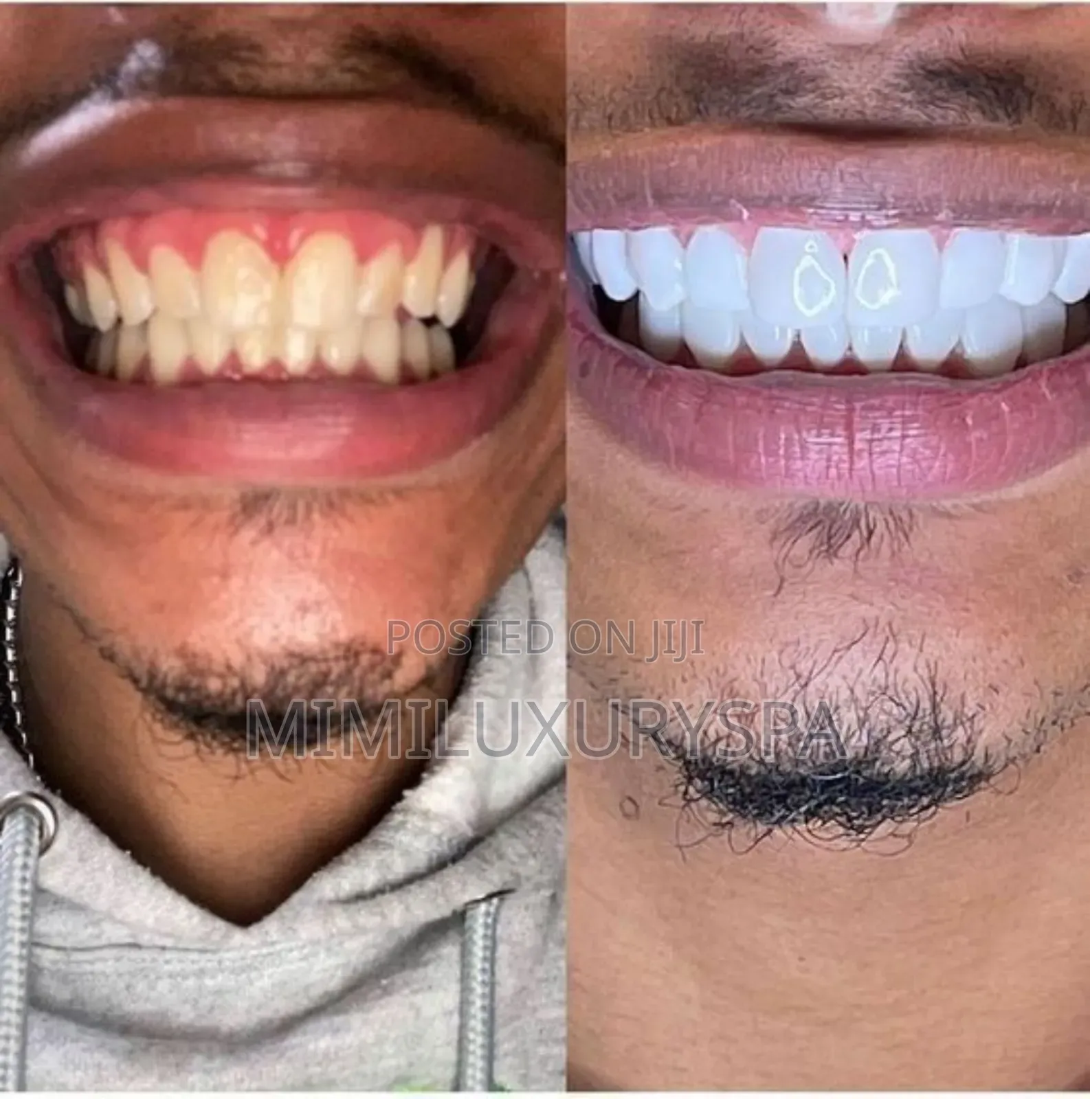 Teeth Whitening