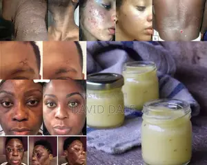 Mdac Acne Pimple Real Performer Treatment