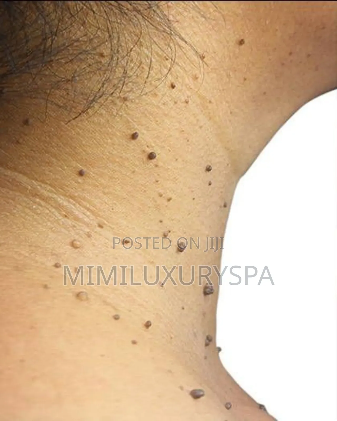 Skin Tag Removal
