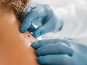 Skin Tag Removal