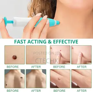 Photo - Skin Tag Removal Kit - 2-in-1 Painless Wart Remove