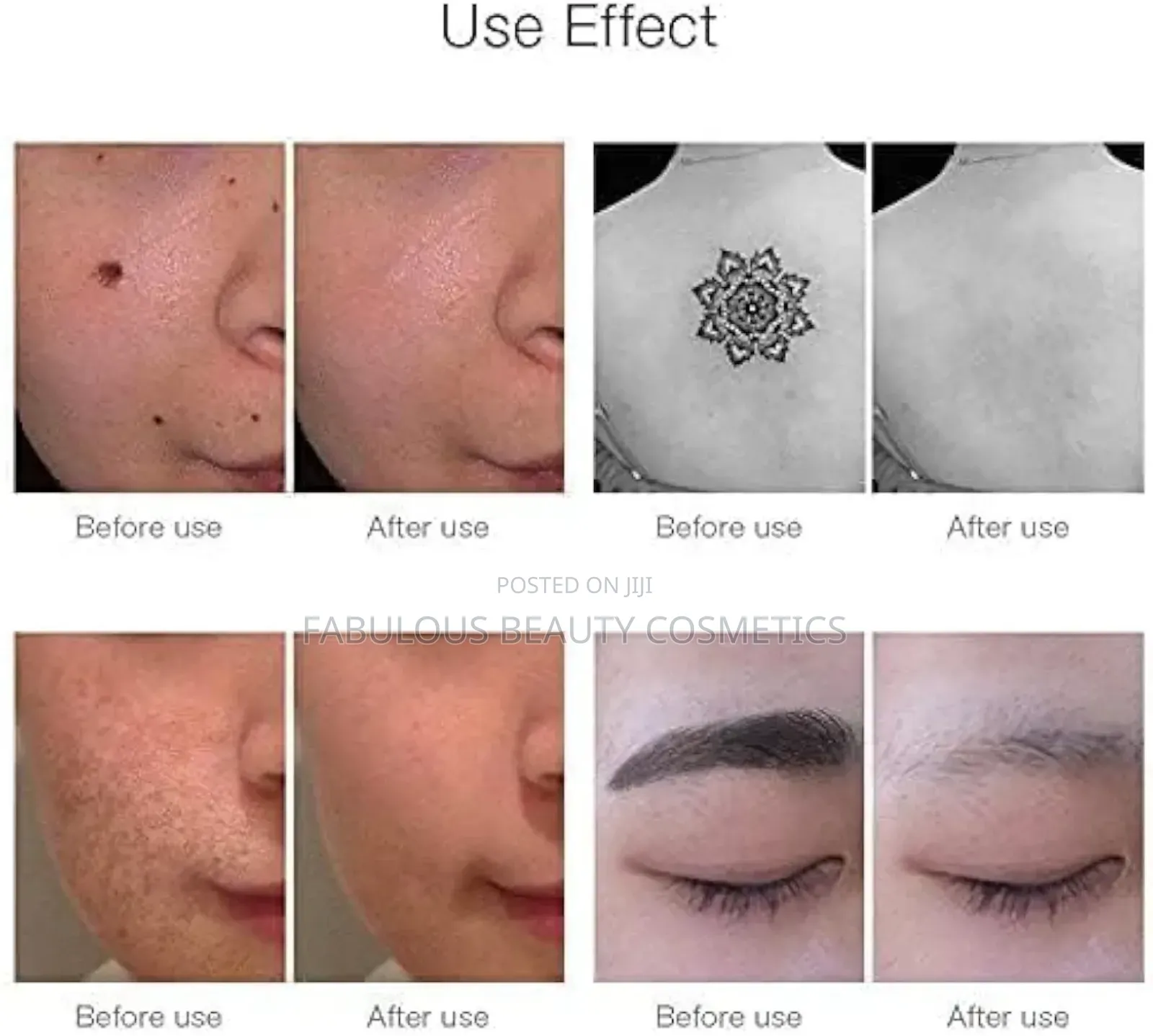 Picosecond Laser Pen Light Therapy Tattoo Scar Mole Removal