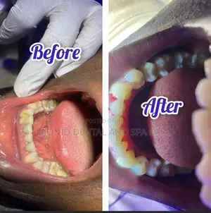 Teeth Cleaning (Scaling and Polishing)