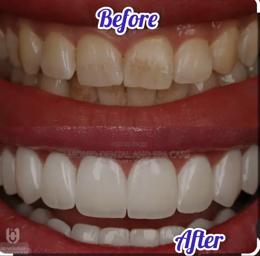 Teeth Whitening