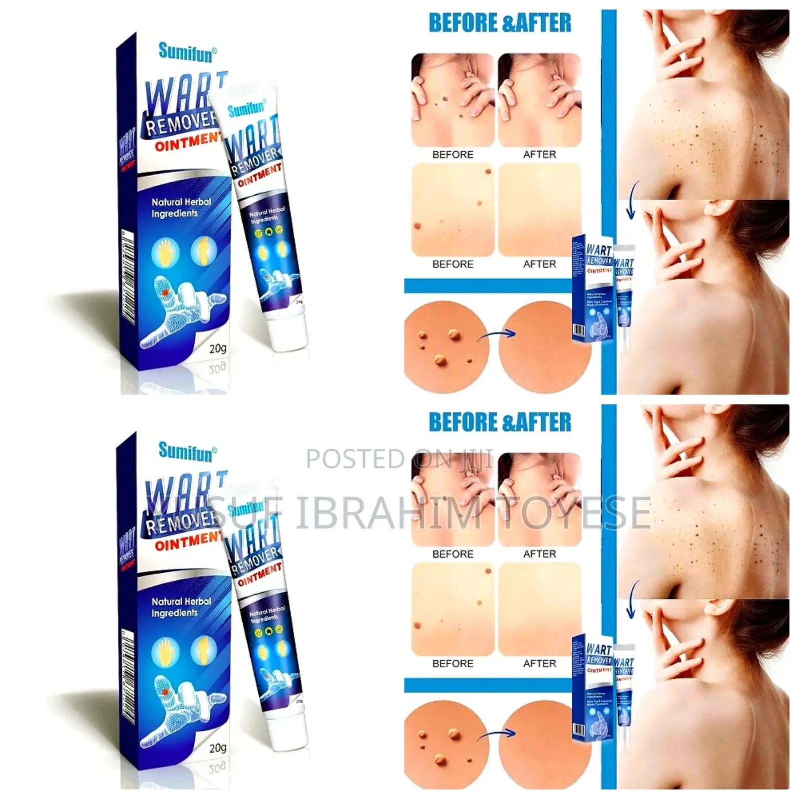 Natural and Fast Acting Skin Tag Removal