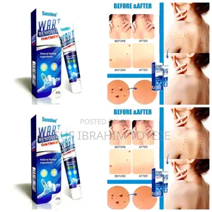 Natural and Fast Acting Skin Tag Removal